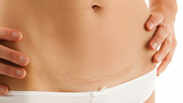 Điểm danh 3 nhóm thực phẩm mẹ sau sinh mổ nhất định phải tránh xa