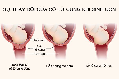 Giai đoạn đầu tiên chuyển dạ