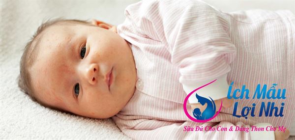Sữa mẹ nóng khiến bé dễ nổi mụn!